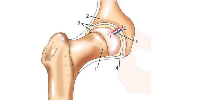 тазобедрена става и артроза